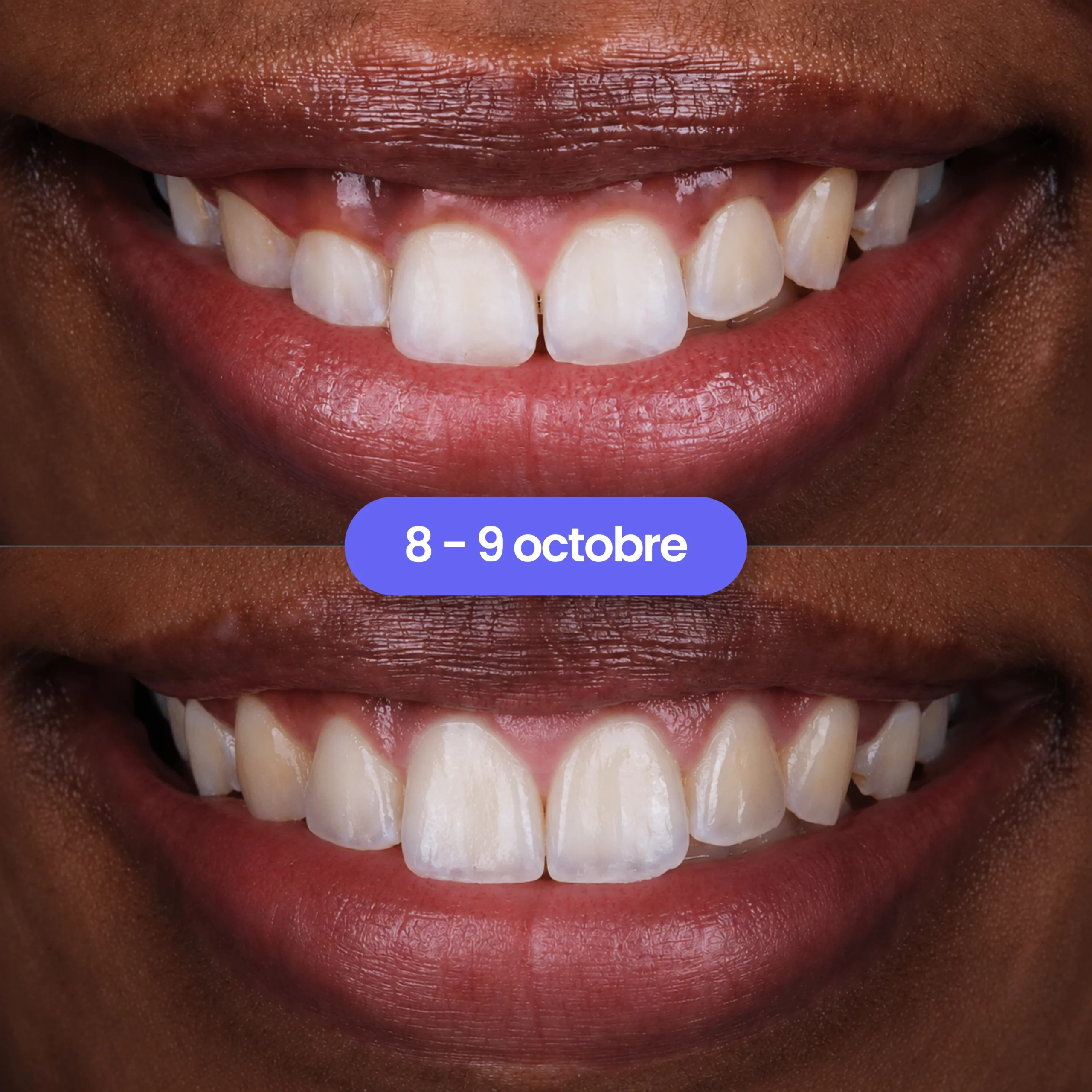 Chirurgie muco-gingivale avancée