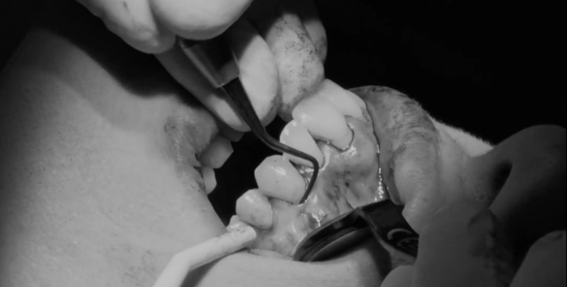 Chirurgie muco-gingivale avancée